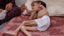 Gaza Strip: Starving children in desperate need of aids as famine unfolds in Gaza