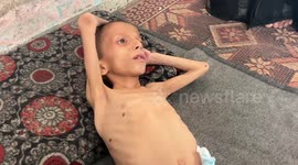 Israel’s deliberate starvation policy in Gaza pushes 10-year-old Palestinian boy to brink of death