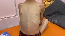 Children suffer from malnutrition amid worsening famine in Gaza Strip