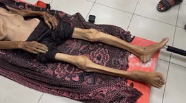 WHO says 148 Palestinians died from malnutrition in Gaza due to Israeli aid blockade