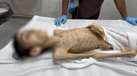 Palestinian teen with cerebral palsy dies of malnutrition in Gaza as famine worsens