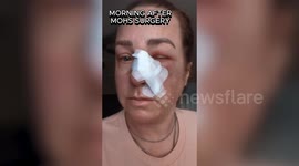 Mom's 'dry skin' on nose turned out to be skin cancer - despite sunscreen obsession