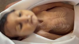 Gazan baby with cerebral palsy succumbs to starvation