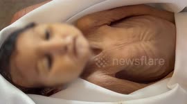Gazan baby with cerebral palsy succumbs to starvation
