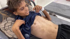 21-year-old Palestinian battles kidney disease amid medical shortages in Israeli-blockaded Gaza