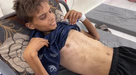 21-year-old Palestinian battles kidney disease amid medical shortages in Israeli-blockaded Gaza