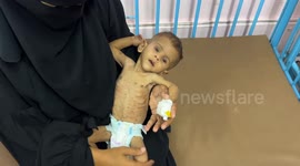 1-year-old malnourished Palestinian baby fights for life amid malnutrition crisis