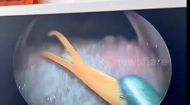 Doctor removes shrimp claw wedged in woman's throat