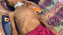 Palestinian child in Gaza wounded in Israeli strike loses sight and hearing