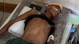 Children wounded in Israeli attack struggle for survival in Gaza