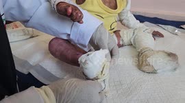 Toddler with rare skin disease faces life-threatening conditions in Gaza