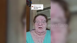 Woman dubbed 'The Thing' from Fantastic Four due to tumours covering body
