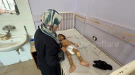 Gaza toddler clings to life under Israel’s inhumane starvation policy