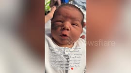 Mum lasering off tot's facial birthmark to