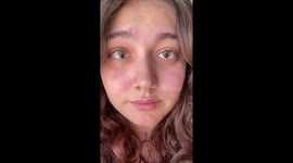 Woman proudly shows her Coloboma eyes on camera