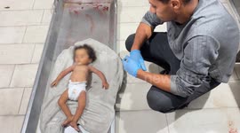 11-month-old Palestinian baby dies of malnutrition in Gaza
