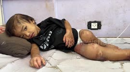 Palestinian toddler fights for survival under Israel’s deliberate starvation in Gaza