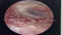 Dozens of baby fleas live on a man's eardrum