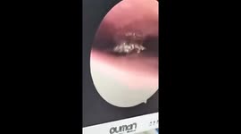 Doctor pulls live cockroach out of patient's nose