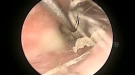 Cotton swab stuck in woman's eardrum