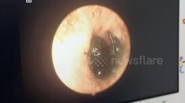 Doctors remove large black bug stuck in five-year-old boy's ear canal