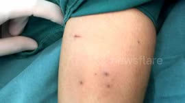 Doctor removes pencil ends out of girl's arm