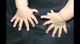 Baby boy with more than 30 fingers and toes