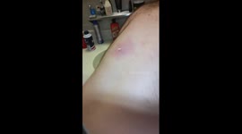 Squirting puss out of an ingrown hair!!!!!!