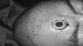 Doctors treat man with 'screw' stuck in his head