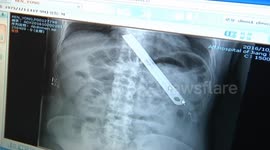 Man swallows 18cm blade after an argument