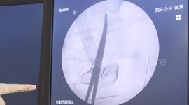 Doctors remove 22 needles from man's stomach