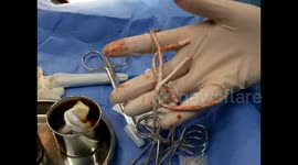 Surgeons operate on man who got 20 cm cable stuck in his urethra