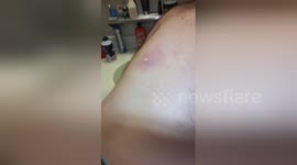 Man squeezes ingrown hair on friend's back, results are really unpleasant