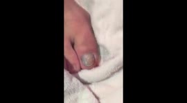 Friends drill through man's injured big toe, causing explosion of pus
