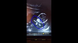 Unborn baby Milly Rocking