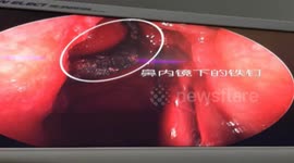 Doctors remove a nail stuck in man's nose for 30 years