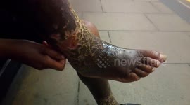 A poor black elderly ladies sitting on the bench crying in pain of mercury infection on the foot
