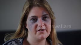 Mystery Illness Which Leaves Face Constantly Covered In Bruises
