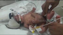 Baby born in India with four legs