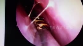 Doctors discover LIVE cockroach inside woman's SKULL