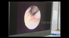 Doctor removes cockroach from man's ear in China