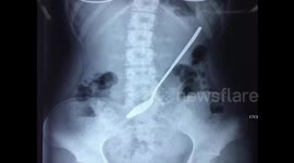 Girl, 18, swallows 20-centimetre-long spoon by mistake