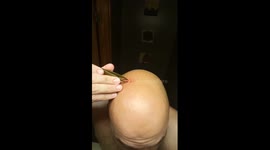 Home Cyst Surgery