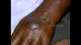 Cutaneous anthrax outbreak in tribal area