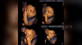 Newsflare Edit - Cheeky wee baby swearing during its scan