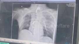 扬州  险！3厘米不锈钢导管断气管里