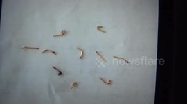12 metal objects removed from man's body