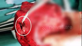 铜川：女子6年来饱受肺部感染困扰 医生切除肺叶取出3厘米小辣椒