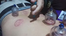 Cupping Very Good For Throwing Toxins In The Blood