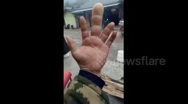 Man in China's Sichuan shows off his massive finger